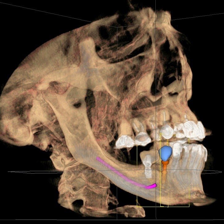 implant